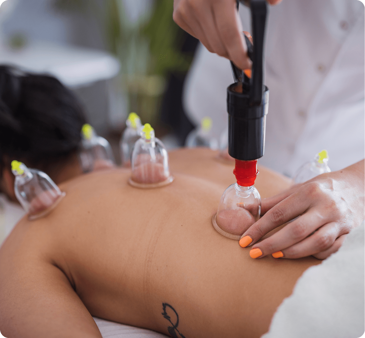 Cupping therapy on person's back